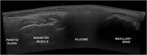 Transverse panoramic ultrasound image of the right cheek with the characteristic “snowstorm” sign between the masseter muscle and maxillary bone.