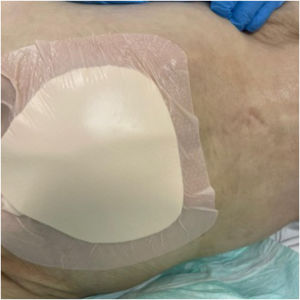 Prophylactic polyurethane foam and silicone dressing on the sacral region in a patient at high risk for developing pressure injuries.