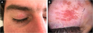 (A) Multiple micropapules, 1 to 2 mm in diameter, grouped on an erythematous base and confluent on the right upper eyelid. (B) Dermoscopy shows polylobulated lesions with a rounded appearance, sparing follicular openings, on an orange-reddish background, and short telangiectatic vascular structures surrounding follicular openings.