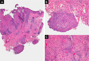 (A) Multinodular dermal inflammatory infiltrate (Hemaxitolyn & eosin, ×40). (B) The infiltrate consists of lymphocytes, plasma cells, and histiocytes forming epithelioid granulomas (Hemaxitolyn & eosin, ×200). (C) Some granulomas show central necrosis (Hemaxitolyn & eosin, ×200).