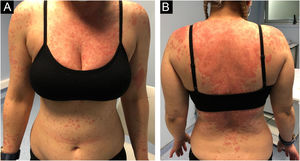 (A‒B) Subacute cutaneous lupus showing annular erythematous plaques coalescing into polycyclic plaques with raised borders and scaling before treatment.