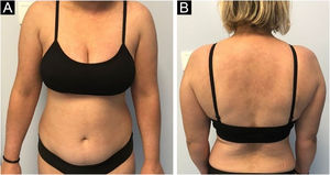 (A‒B) Improvement after two infusions of anifrolumab with total resolution of the lesions.