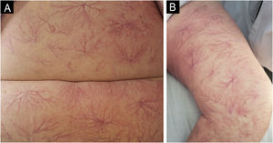 Clinical images. Multiple generalized dendritic type telangiectasias on the abdomen (A) and thigh (B).