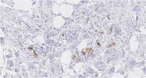 Immunohistochemistry showing hyperchromatic cells showing positive immunohistochemical staining with the CD20 B-cell marker (×400).