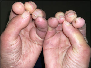 Skin-coloured papules, distributed on the pulp of fingers of both hands.