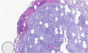 Histopathological examination showing a cutaneous nodule with epidermal hyperplasia and a dense dermal infiltrate extending into the deep dermis and subcutaneous tissue, with areas of granulomatous inflammation (Hematoxylin & eosin, ×10).