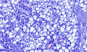 Histopathological examination showing dermal macrophages containing numerous intracellular amastigotes (Giemsa, ×1000).
