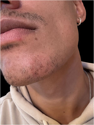 Physical examination reveals only post-inflammatory hyperpigmentation.