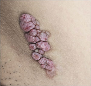 Clinical image. Multiple pink dome-shaped papules with central umbilication and some with erosions on the surface, arranged in a linear plaque.