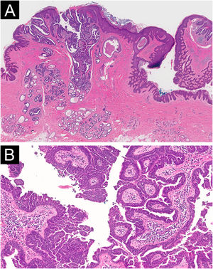 (A) Histopathological image (Hematoxylin & eosin, 20×): Epidermal and dermal tumor. The epidermis shows hyperkeratosis and acanthosis with invaginations composed of papillary projections. (B) Histopathological image (Hematoxylin & eosin, 100×): Tubulo-papillary structures lined by a bilayer cuboidal epithelium with focal stratification and some evidence of apical secretion by decapitation. The tumoral stroma contains numerous plasma cells. No cellular atypia was observed.