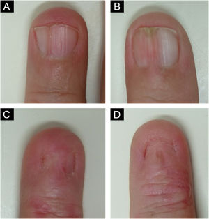 Variability of nail involvement (A) Vertical ridges. (B) Mild pterygium. (C) Severe pterygium. (D) Anonychia. The skin of the distal phalanges of the most affected nails (C‒D) shows mild erythema and desquamation.