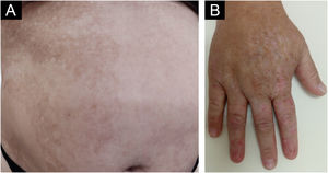 (A) Segmental hyperpigmented macules on the right abdomen. (B) Segmental hypo- and hyperpigmentation located on the dorsum of the right hand.