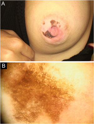 (A) Two irregularly bordered hyperpigmented patches on the nipple-areola complex in the first patient. (B) Dermoscopic image showing a pigmented background with circular structures forming a ring pattern in the first patient.