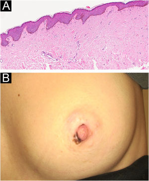 (A) Histopathological findings of the first patient: basal melanin hyperpigmentation, epidermal acanthosis, and elongation of rete ridges (Hematoxylin & eosin, ×10). (B) Partial regression of the lesions after four sessions of superficial cryotherapy in the first patient.
