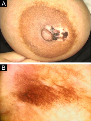 (A) A 3 cm hypopigmented patch interspersed with irregularly pigmented macules on the areola in the second patient. (B) Dermoscopic image showing circular structures forming a ring pattern and a fish scale-like pigmentation variant in the second patient.