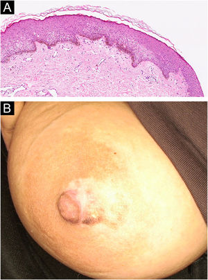 (A) Histopathological findings of the second patient: irregular acanthosis, elongation of rete ridges, increased basal melanin, dermal edema, melanin incontinence, and perivascular lymphocytic infiltration (Hematoxylin & eosin, ×10). (B) Partial regression of the lesion without treatment after five years in the second patient.