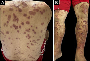 Cutaneous manifestations. (A) Erythematous-violaceous papules and plaques, with edematous edges, some with a tendency to coalesce, on the back. (B) Palpable purpura on the lower limbs.