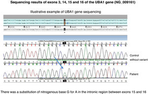 Genetic testing of the UBA1 gene with DNA sequencing using the Sanger method of exons 3, 14, 15 and 16. Mutation identified between exons 15 and 16, with the nitrogenous base G being replaced by A.