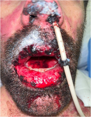 Hemorrhagic cheilitis and tongue ulcers, prior to the initiation of low-level laser therapy.