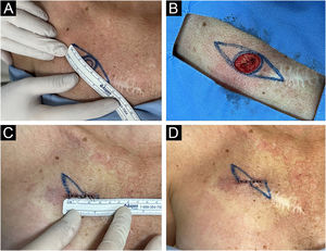 Clinical photographs of the surgical procedure steps. (A) Marking and measuring the fusiform excision diameter from the 0.4 cm circular margin of the lesion according to the skin tension lines. (B) Surgical defect after excision of the lesion at the circular margin. (C) Measurement of the final scar for comparison with the programmed fusiform excision diameter. (D) Final scar: smaller and with a different orientation than the fusiform design.