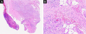 Pathological and immunohistochemical specimens. (A) Low-power view showed ulceration formation, increased vascular proliferation and dilation (Hematoxylin & eosin, ×50). (B) The infiltration of perivascular lymphocytes and swollen vessel walls with fibrinoid necrosis, erythrocyte exosmosis (original magnification: ×400).