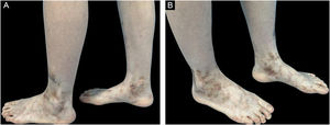 After 6-weeks of treatment with Upadacitinib, the patient manifested significant improvement in erythema and pain, achieved nearly complete resolution of ulceration and remained only hyperpigmentation.