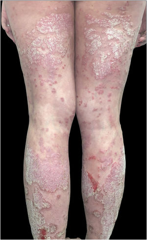 Patient with extensive plaque psoriasis prior to the initiation of biologic therapy with ustekinumab.