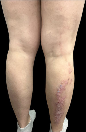 Patient receiving treatment with risankizumab, demonstrating persistence of a linear plaque following Blaschko’s lines.