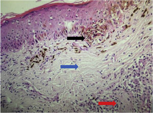 Anatomopathological image of recurrent melanocytic nevus showing a trizonal pattern: lentiginous junctional component (black arrow), cicatricial dermal fibrosis (blue arrow), nests of nevus cells (red arrow; Hematoxylin & eosin, ×200).