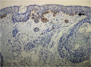 Immunohistochemical analysis image of recurrent melanocytic nevus showing a gradient pattern: strongly positive expression in the junctional component (black arrow) and gradually decreasing expression in the deep components. (HMB-45 immunostaining ×100).