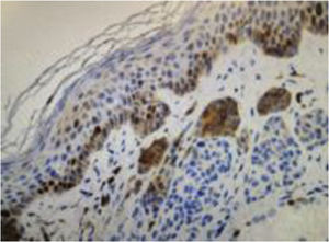 Image of immunohistochemical analysis of recurrent melanocytic nevus showing staining for the Ki-67 antibody. (Ki-67 immunostaining ×200).