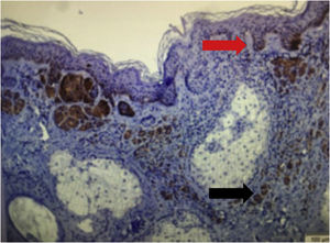 Image of immunohistochemical analysis of recurrent melanocytic nevus showing the expression of the BRAF mutation in the junctional (red arrow) and dermal (black arrow) components (BRAF immunostaining ×100).