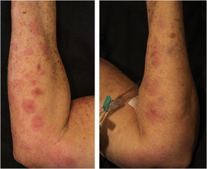 Erythematous and painful nodules affecting the entire length of the upper limbs. Erythematous and painful nodules affecting the entire length of the upper limbs.