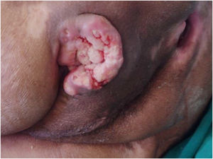 Marjolin's ulcer in a young paraplegic patient with a pressure injury in the ischial location for 15-years. Marjolin's ulcer in a young paraplegic patient with a pressure injury in the ischial location for 15-years.