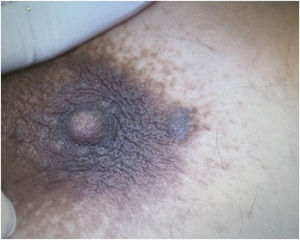 Patient in Case 1. Normochromic papule in relation to the mammary areola tissue, measuring approximately 5 mm, with regular contours and well-defined, located on the lateral margin of the areola. Patient in Case 1. Normochromic papule in relation to the mammary areola tissue, measuring approximately 5 mm, with regular contours and well-defined, located on the lateral margin of the areola.