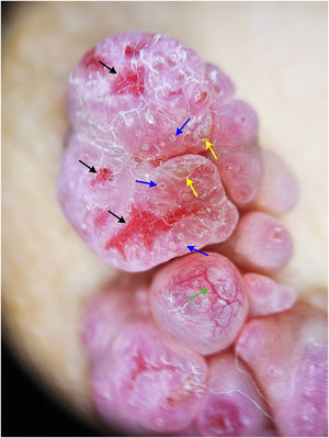 Dermoscopy image (×10): Pink papillomatous structures with erosions (black arrows), white circles (blue arrows), yellowish crusts (yellow arrows), and telangiectasias (green arrow). Dermoscopy image (×10): Pink papillomatous structures with erosions (black arrows), white circles (blue arrows), yellowish crusts (yellow arrows), and telangiectasias (green arrow).