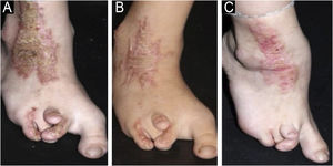 CHILD nevus on the right lower limb associated with dysplasia. (a) Recurring lesion after nine years of use of 2% Lovastatin + 2% cholesterol. (b) Partial improvement with replacement with 2% simvastatin + 2% cholesterol. (c) Significant improvement after replacement with topical 2% atorvastatin + 2% cholesterol.