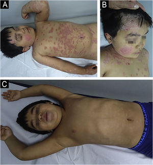 (A) Six-year-old male patient diagnosed with psoriasis, presenting with intensely pruritic, erythematous, and scaly plaques on the face, scalp, and both anterior and posterior trunk. (B) Same patient after 22 biweekly sessions of nb-UVB phototherapy, showing significant clinical improvement with marked reduction in erythema, scaling, and pruritus.