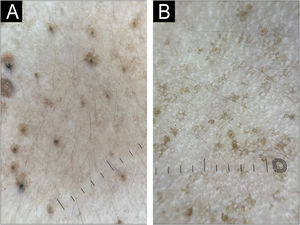 Dermoscopy (polarized, 10× magnification) demonstrating central dark brown follicular plugs surrounded by irregular star-shaped and Chinese letter-like brown pigmentation (A). Dermoscopy (polarized, 10× magnification) demonstrating Chinese letter-like pigmentation centered around a follicular opening (B).