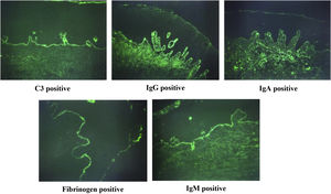 Characteristic DIF fluorescence patterns. DIF demonstrated continuous and homogeneous linear green fluorescence for C3 and IgG along the BMZ, with positive linear staining for IgA, IgM, and fibrinogen observed in a subset of cases.