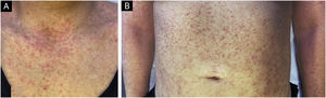 Crusted erythematous papules on the neckline (A) and abdomen (B). Clinical findings are compatible with Darier-White disease.