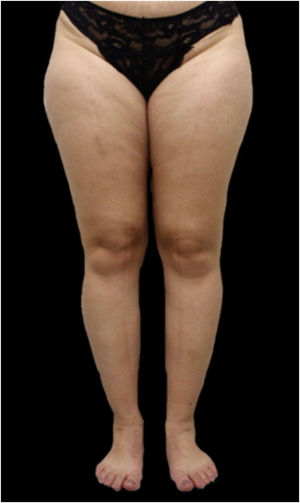 Lipedema, type II. Note the presence of spontaneous hematoma in the right lower limb.