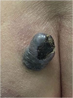 Exophytic nodule, bluish in color, with central ulceration and a discrete area of ​​irregular, blackened spot at the base, measuring approximately 5 cm in diameter at its longest axis, located on the left buttock. Erythema is also observed at the upper left pole of the lesion.