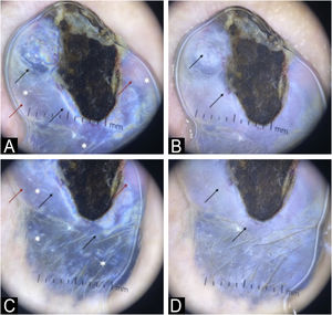 (A) Dermoscopy (×10) with polarized light: Upper pole of the lesion showing a diffuse, exuberant rainbow pattern (black arrow) over a bluish area interspersed with reddish-white areas (red arrow). Bright white structures (white asterisk) are present throughout the region. A serohematic structure is observed in the center. (B) Dermoscopy (×10) with immersion, non-polarized light: Upper pole of the lesion showing a bluish area, with evident polymorphic vessels (black arrow). (C) Dermoscopy (×10) with polarized light: Lower pole of the lesion showing a diffuse, exuberant rainbow pattern (black arrow) over a bluish area interspersed with reddish-white areas (red arrow). Bright white structures (white asterisk) are present throughout the region. A serohematic structure is observed in the center. A poorly defined and irregular area is observed in the most distal portion. (D) Dermoscopy (×10) with immersion, non-polarized light: Lower pole of the lesion showing a bluish area, with polymorphic vessels (black arrow) and in the most distal portion of the lesion, a poorly defined and irregular area.