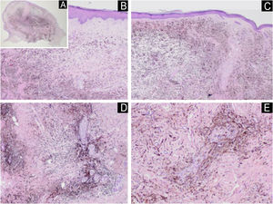 (A) Panoramic view of the lesion showing its polypoid aspect. (B and C) They show diffuse proliferation of isolated dendritic melanocytes, distributed in an isolated manner among collagen fibers or forming bundles, occupying the entire dermis, without compromising the epidermis and with a compromised deep margin. (D) Proliferation of melanocytes involving cutaneous appendages, diffuse proliferation of isolated dendritic melanocytes, distributed in an isolated manner or forming bundles, without compromising the epidermis and with a compromised deep margin (Hematoxylin & eosin, ×20). (E) This melanocytic proliferation compromises nerve fibers of the deep reticular dermis (Hematoxylin & eosin, ×20).