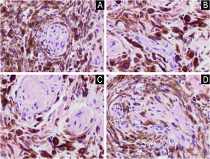 In detail, atypical dendritic melanocytes are noted, with a marked degree of nuclear polymorphism and hyperchromasia, and infiltrating nerve fibers in Figures A, B, C and D (Hematoxylin & eosin, ×100).