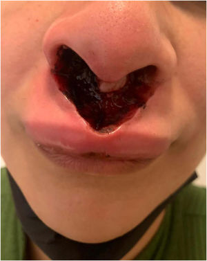 Well-defined necrotic ulcer, located from the nasal columella to the philtrum.