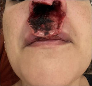 Necrotic ulcer affecting the orbicularis oris muscle and extending to the submucosa of the upper lip.