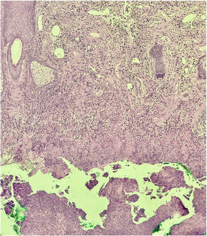 Necrotic area evident in the deep dermis. (Hematoxylin & eosin, ×100).