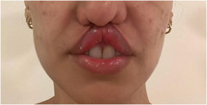 Significant retraction of the upper lip with loss of the philtrum and relevant aesthetic impairment after hospitalization.